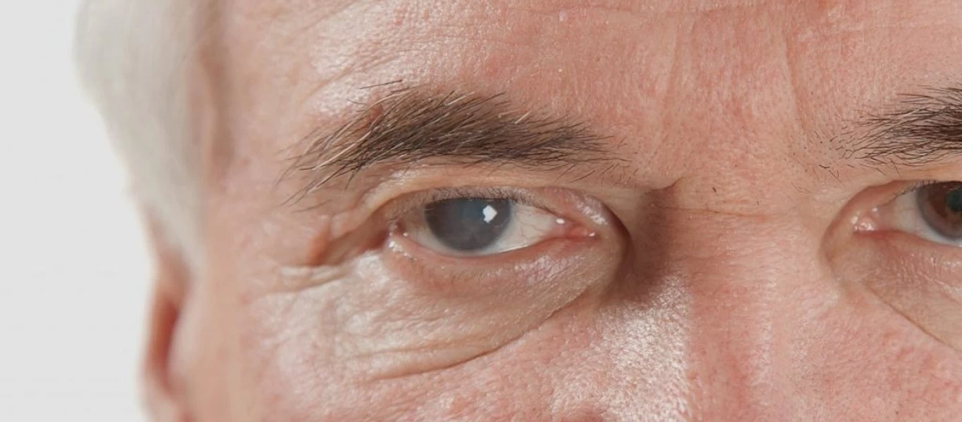 Όλα όσα πρέπει να γνωρίζετε για το γλαύκωμα: Συμπτώματά και πως να το αντιμετωπίσετε